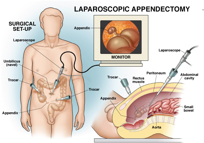 Appendisectomy